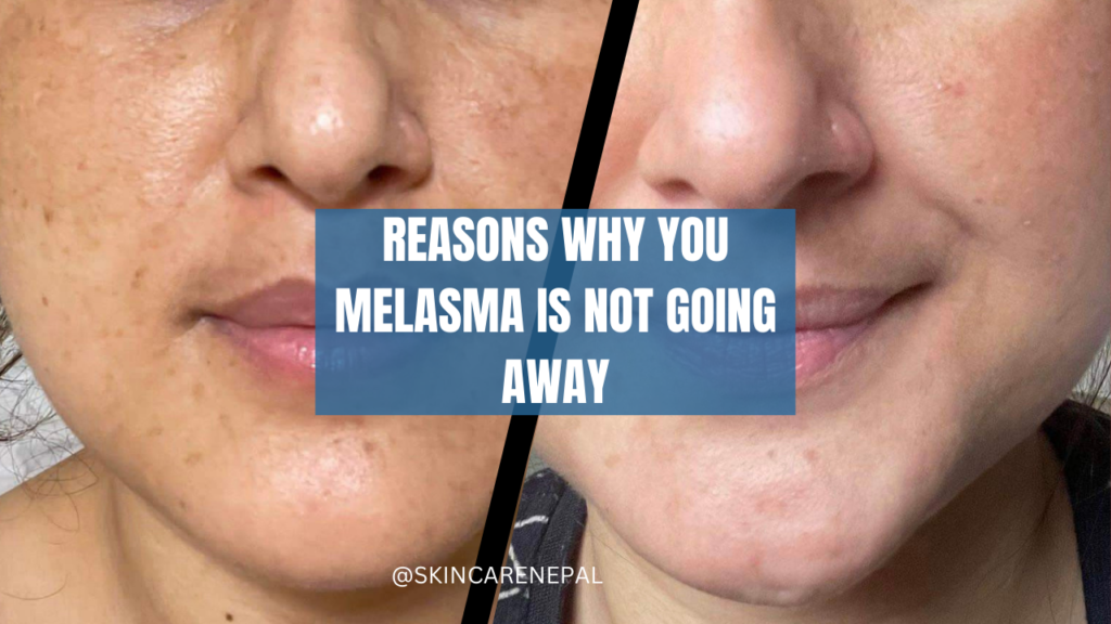 REASONS WHY YOUR MELASMA IS NOT GOING AWAY