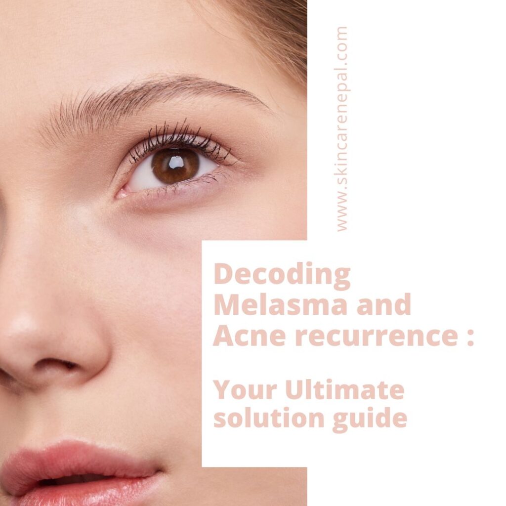 Decoding Melasma and Acne Recurrence: Your Ultimate Solution Guide